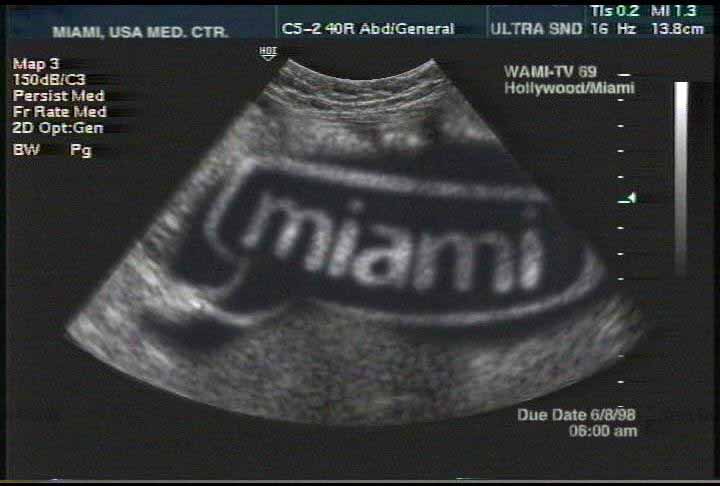 miami Bubble Sonogram
